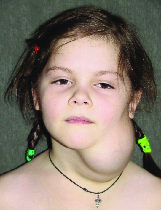 Девочка с лимфангиомой боковой поверхности шеи до операции