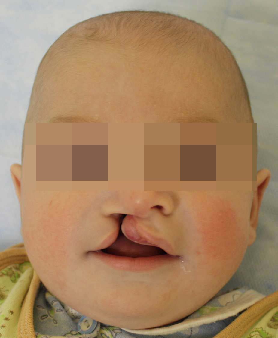 Пациент с односторонней расщелиной после лечения (возраст 5,5 месяцев)