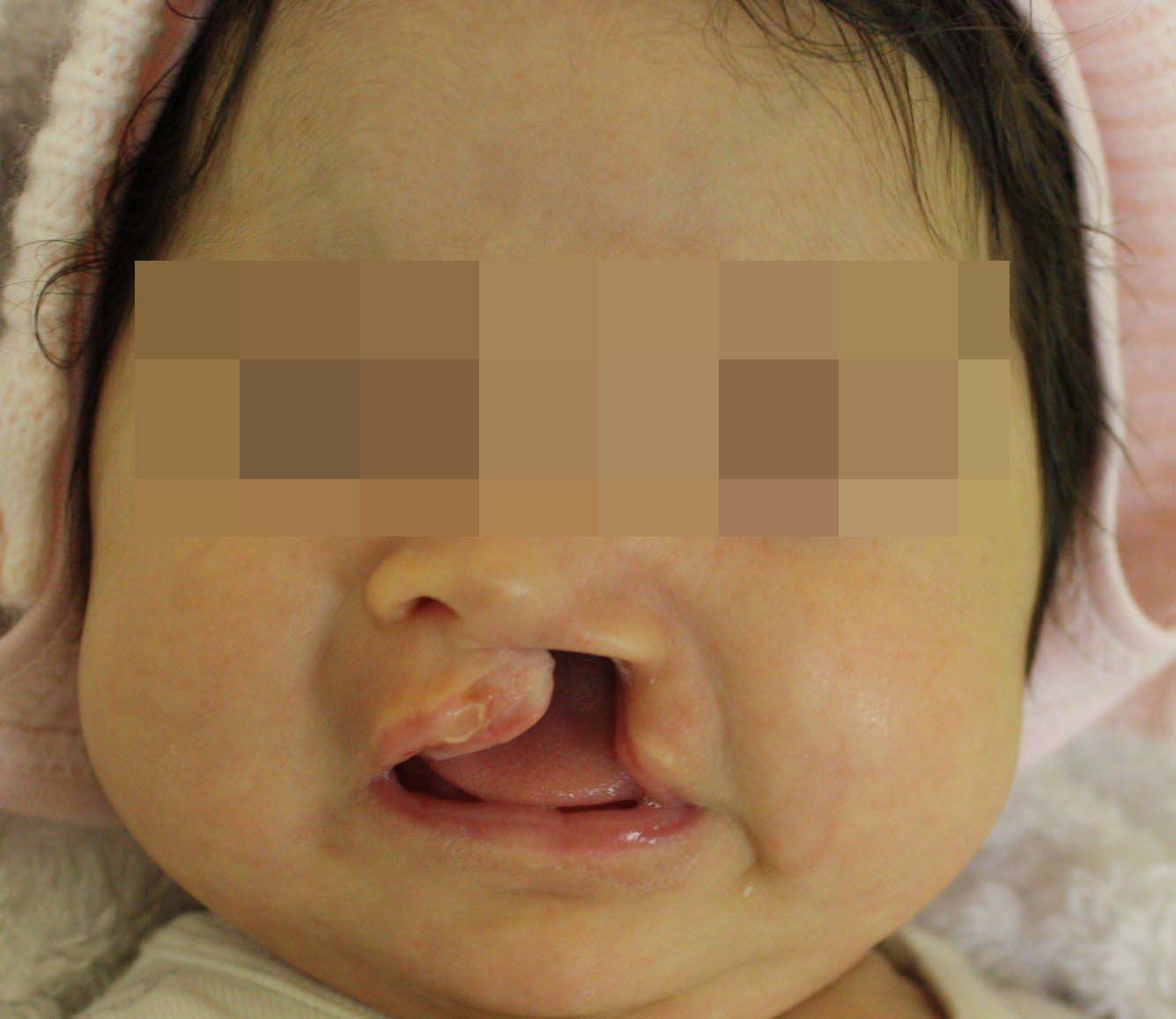 Пациентка с односторонней расщелиной до лечения (возраст 1 месяц)