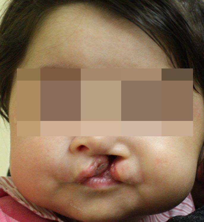 Пациентка с односторонней расщелиной после лечения (возраст 5,5 месяцев)