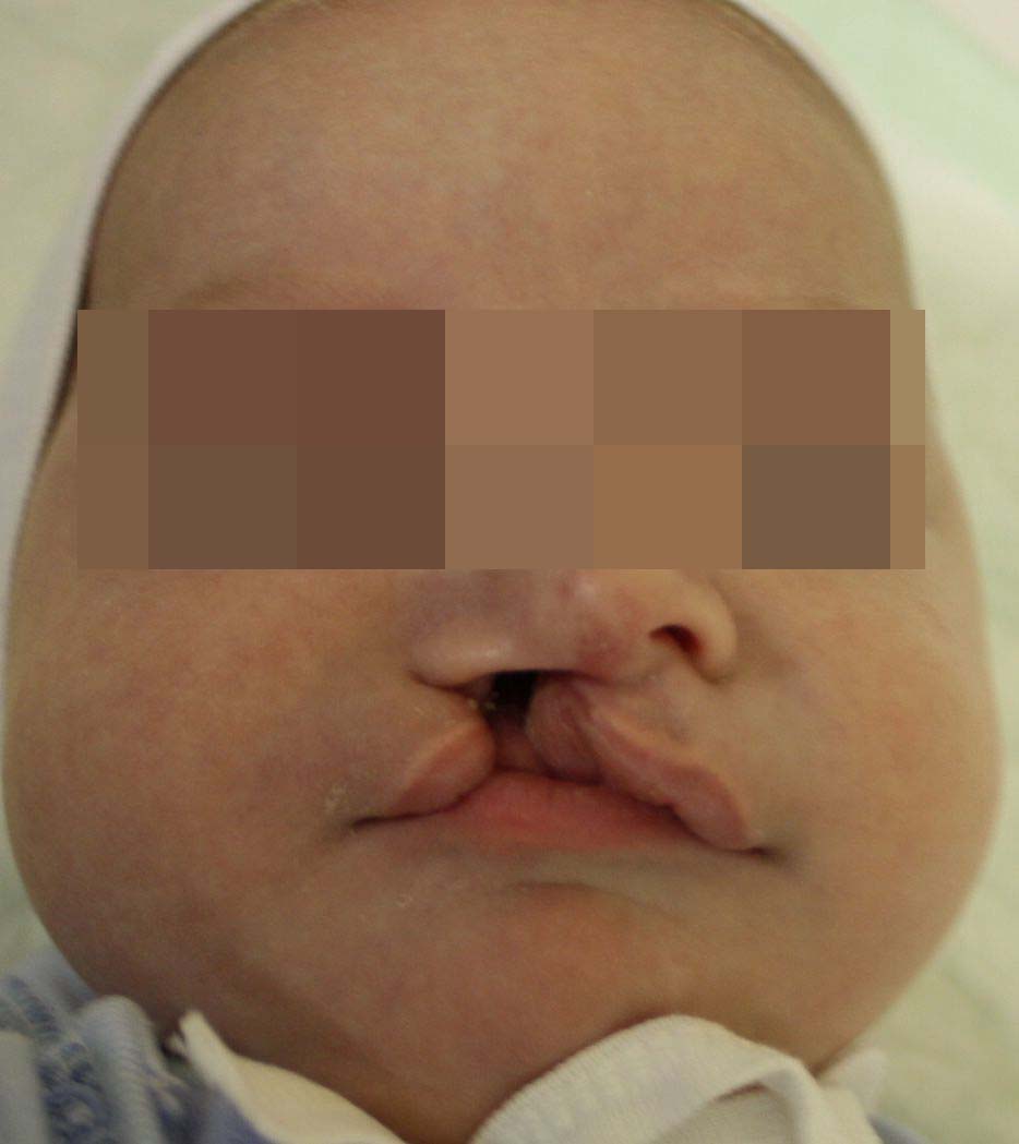 Пациент с односторонней расщелиной до лечения (возраст 1 месяц)