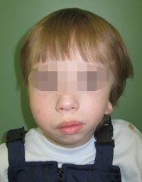 Синдром Гольденхара 1. Вид спереди