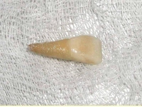 реплантация зуба